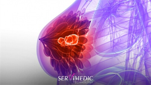 Dicas Para a Prevenção do câncer de Mama Dicas Para a Prevenção do câncer de Mama