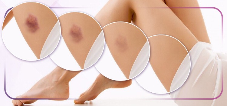 foto de perna com equimose