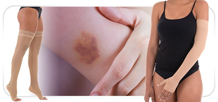 foto de equimose e pessoa usando meia de compressao para tratamento de equimose