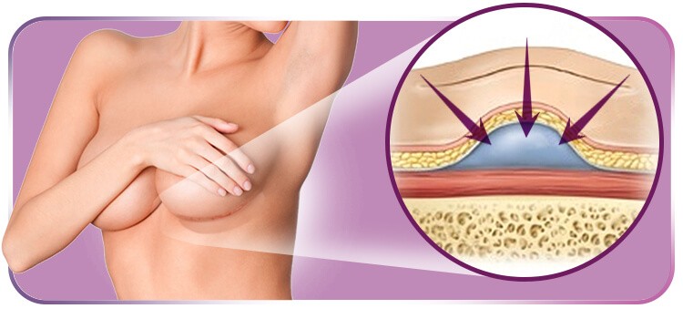 Ilustração do seroma