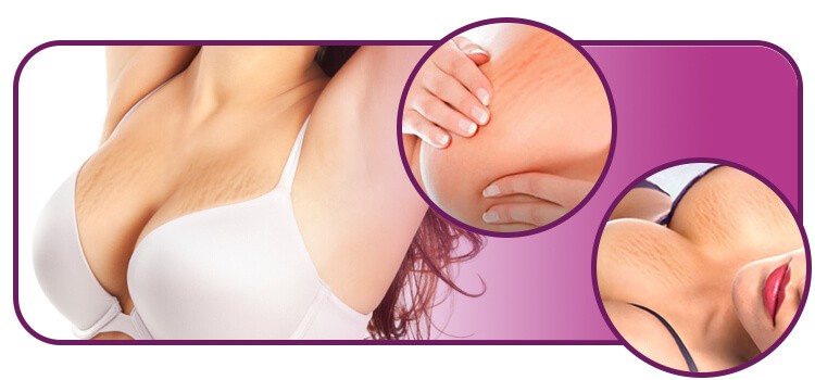 Estrias no peito: conheça as causas e os melhores tratamentos