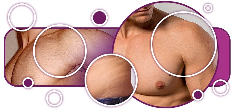 Estria masculina: conheça as causas e tratamentos 