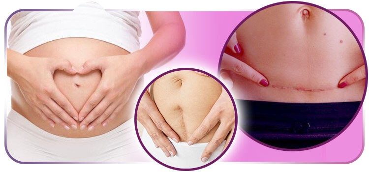 O que saber sobre cicatrizes de cesariana