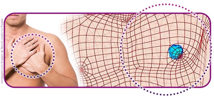 Diagnóstico de câncer de mama em homem