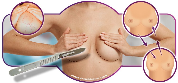 Como funciona a cirurgia reparadora de mama