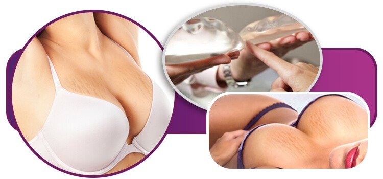 Prótese de Silicone e a Elasticidade da Pele