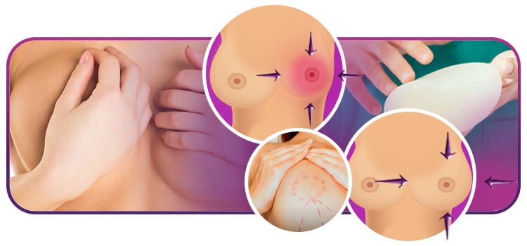 Quando Devo Trocar Minhas Próteses de Silicone?