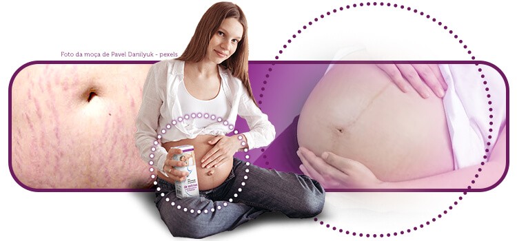 Estrias: Dicas e truques para uma barriga lisa durante a gravidez