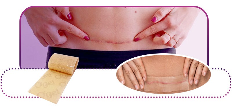 foto de cicatrizes de abdominoplastia