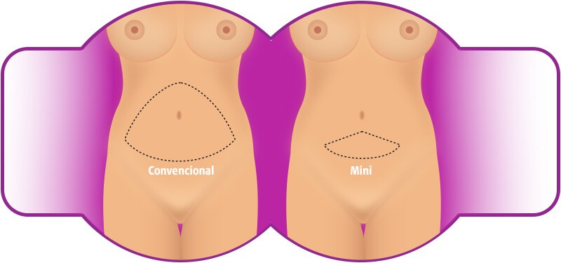 foto ilustrada de método de fazer abdominoplastia