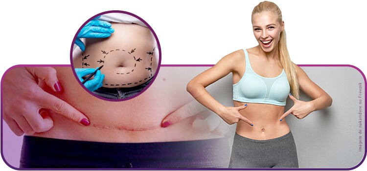 Como cuidar da cicatriz de abdominoplastia