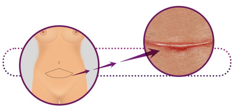 Queloide na cicatriz de abdominoplastia