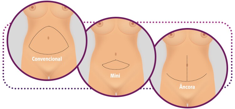 Tamanhos da cicatriz de abdominoplastia