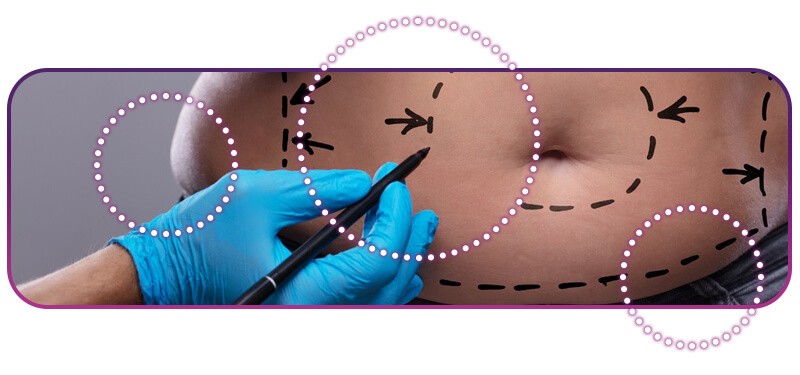 marcação de abdominoplastia