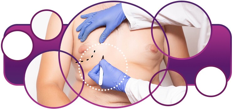 cirurgia plástica masculina mamas