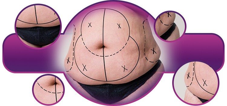 principais cirurgias para emagrecer