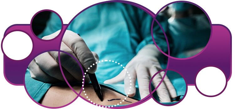 escolher cirurgia para emagrecer