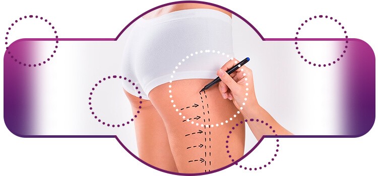 eliminar celulite