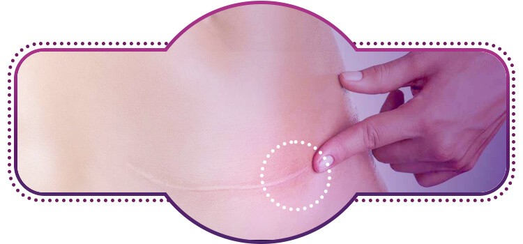 Aderencia_cicatricial