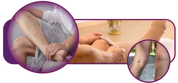 tratamento de varizes - opções