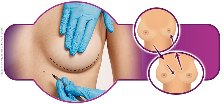 Troca de prótese de silicone